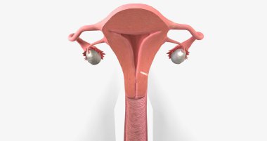 Cervical cancer is a disease that affects the cervix, characterized by tumor growth. 3D rendering