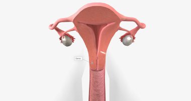Cervical cancer is a disease that affects the cervix, characterized by tumor growth. 3D rendering