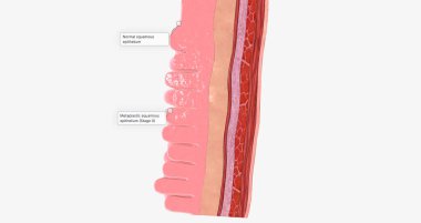 Adenocarcinoma of the esophagus results from abnormal cell mutations and growth in the esophageal lining, or mucosa. 3D rendering