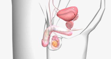 In stage IB, the tumor has spread to the epididymis or vessels within the testicle, spermatic cord, or the scrotum. 3D rendering