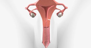Cervical cancer is a disease that affects the cervix, characterized by tumor growth. 3D rendering
