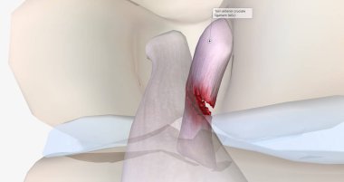 A tear in the anterior cruciate ligament is one of the most common knee injuries. 3D rendering