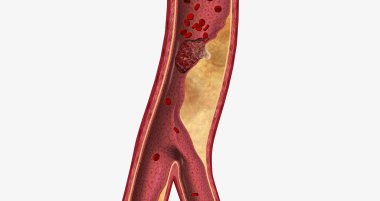 Atherosclerosis is a cardiovascular disease characterized by the gradual buildup of plaque in artery walls. 3D rendering