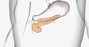 Cystic fibrosis (CF) is a genetic disorder characterized by thick mucus production. 3D rendering