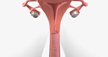 In stage I, the cancer is very small and confined to the cervix 3D rendering