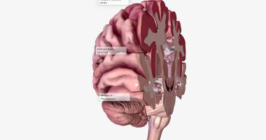 Alzheimer's Disease Brain Cross Section 3D rendering