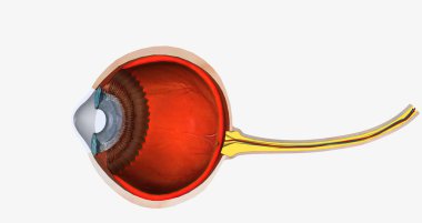 Keratoconus is an eye disease that affects the structure of the cornea. 3D rendering