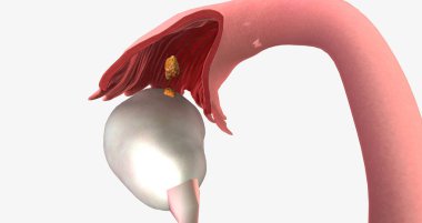 Stage I ovarian cancer has a detectable tumor and has spread to one or both the ovaries. 3D rendering
