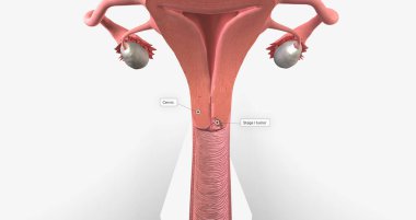 In stage I, the cancer is very small and confined to the cervix 3D rendering