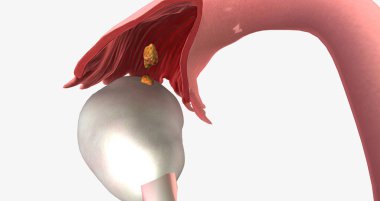 Stage I ovarian cancer has a detectable tumor and has spread to one or both the ovaries. 3D rendering
