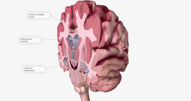 Alzheimer's Disease Brain Cross Section 3D rendering