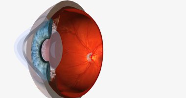 Keratoconus is an eye disease that affects the structure of the cornea. 3D rendering