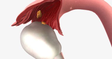 Stage I ovarian cancer has a detectable tumor and has spread to one or both the ovaries. 3D rendering