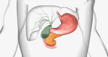 Gallstones are pieces of solid material that form in the gallbladder, a small hollow organ located beneath the liver. 3D rendering clipart