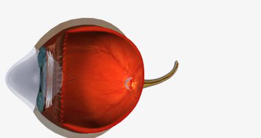 Keratoconus is an eye disease that affects the structure of the cornea. 3D rendering