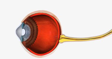 Keratoconus is an eye disease that affects the structure of the cornea. 3D rendering