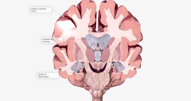 Alzheimer's Disease Brain Cross Section 3D rendering