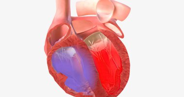 Atrial Septal Defect, Blood Flow 3D rendering