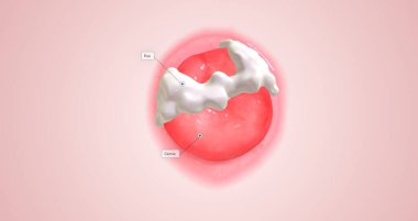 In women, chlamydia bacteria infect the cervix, causing cervical inflammation, pus production, and discharge.3D rendering