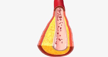 Atherothrombosis is a cardiovascular disease characterized by ruptured atherosclerotic plaque and clot formation. 3D rendering