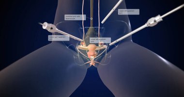 A hysterectomy is a surgical procedure to remove the uterus. 3D rendering