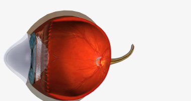 Keratoconus is an eye disease that affects the structure of the cornea. 3D rendering
