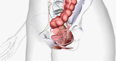 In stage IV, the cancer spreads to invade nearby organs, such as the bladder, rectum, and kidneys. 3D rendering clipart