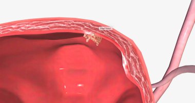 In stage I bladder cancer 3D rendering