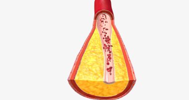 Atherothrombosis is a cardiovascular disease characterized by ruptured atherosclerotic plaque and clot formation. 3D rendering