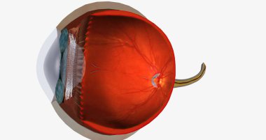 Higher than normal intraocular pressure in the absence of ocular hypertension, optic nerve damage, or visual field loss 3D rendering