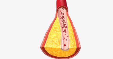 Atherothrombosis is a cardiovascular disease characterized by ruptured atherosclerotic plaque and clot formation. 3D rendering