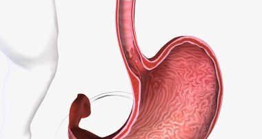 Barretts esophagus is a condition in which the tissue lining the esophagus is replaced by tissue that is similar to the intestinal lining. 3D rendering