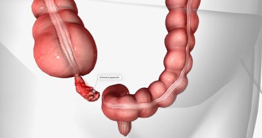 Appendicitis is the inflammation of the appendix, a thin, tube-like organ attached to the large intestine. 3D rendering clipart