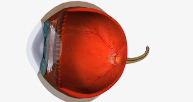 Higher than normal intraocular pressure in the absence of ocular hypertension, optic nerve damage, or visual field loss 3D rendering
