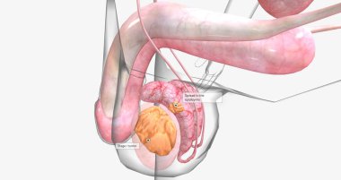 In stage IB, the tumor has spread to the epididymis or vessels within the testicle, spermatic cord, or the scrotum. 3D rendering