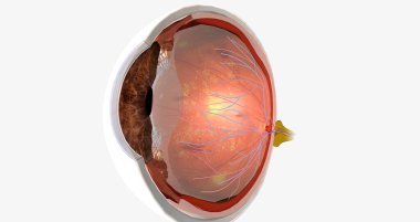 Diabetic retinopathy is a complication of diabetes that affects the eyes. 3D rendering