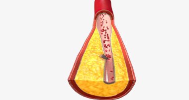 Atherothrombosis is a cardiovascular disease characterized by ruptured atherosclerotic plaque and clot formation. 3D rendering