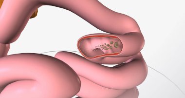Glucose is the body primary source of fuel and is either converted into energy within cells 3D rendering