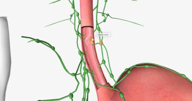 In stage II esophageal cancer, the tumor has spread to certain areas of the esophageal wall. 3D rendering