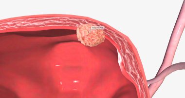 The Bladder Cancer, Stage II 3D rendering