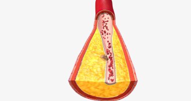 Atherothrombosis is a cardiovascular disease characterized by ruptured atherosclerotic plaque and clot formation. 3D rendering