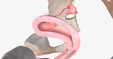 Endometrial polyps are abnormal growths of the inner lining of the uterus, known as the endometrium. 3D rendering