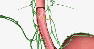 In stage II esophageal cancer, the tumor has spread to certain areas of the esophageal wall. 3D rendering