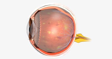 Diabetic retinopathy is a complication of diabetes that affects the eyes. 3D rendering