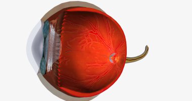 Higher than normal intraocular pressure in the absence of ocular hypertension, optic nerve damage, or visual field loss 3D rendering