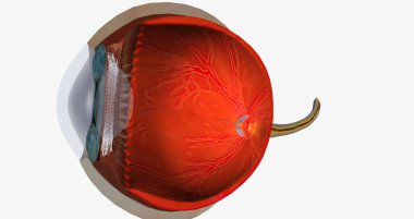 Higher than normal intraocular pressure in the absence of ocular hypertension, optic nerve damage, or visual field loss 3D rendering