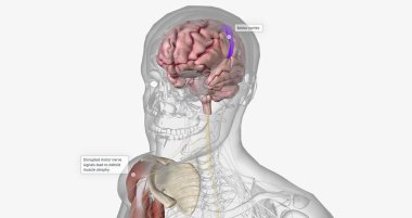 Amyotropic lateral sclerosis (ALS) is a progressive neurodegenerative disorder caused by the death of motor neurons. 3D rendering