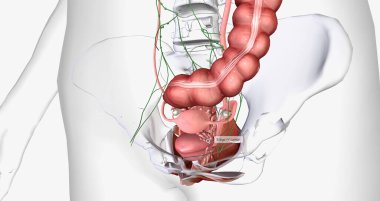 In stage IV, the cancer spreads to invade nearby organs, such as the bladder, rectum, and kidneys. 3D rendering