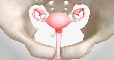 Chlamydia is a sexually transmitted infection caused by Chlamydia trachomatis bacteria.