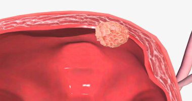 The Bladder Cancer, Stage II 3D rendering